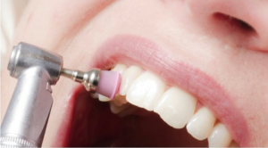 Limpieza dental